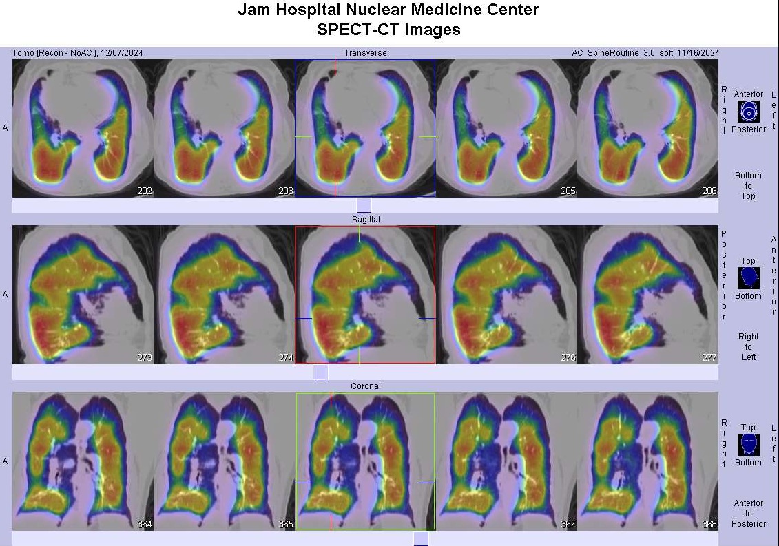 lung SPECT-CT